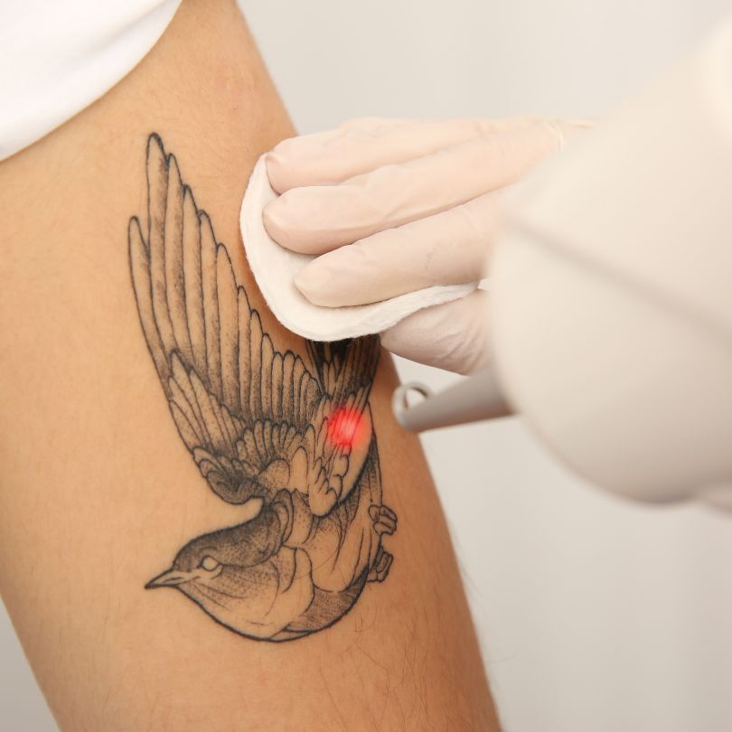 Tattoo removal