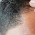 Trasplante capilar FUE: lo que debes saber antes de decidirte